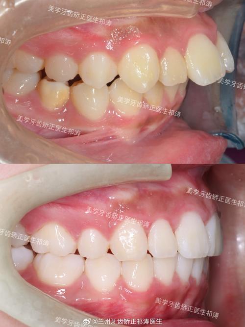 牙齿有点不整齐，矫正真的有必要吗？-图3