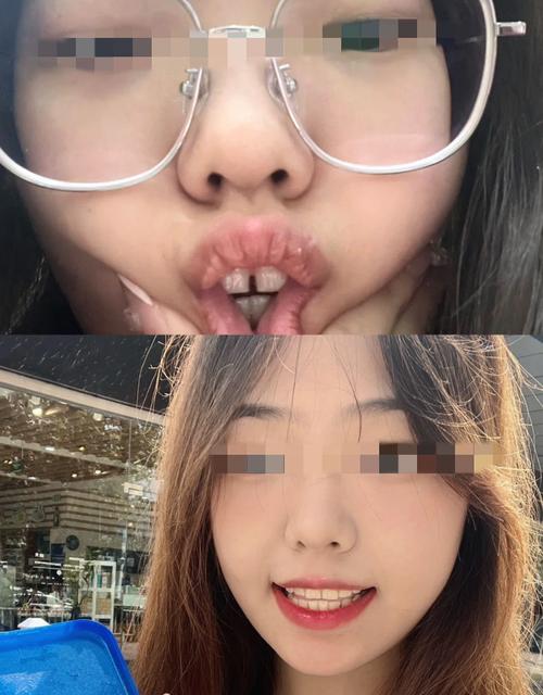 矫正后牙缝很大，是什么原因？该怎么解决？-图1