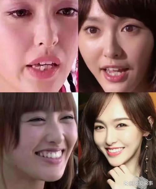 明星如何悄悄矫正牙齿？藏着哪些高效又隐蔽的方法？-图2
