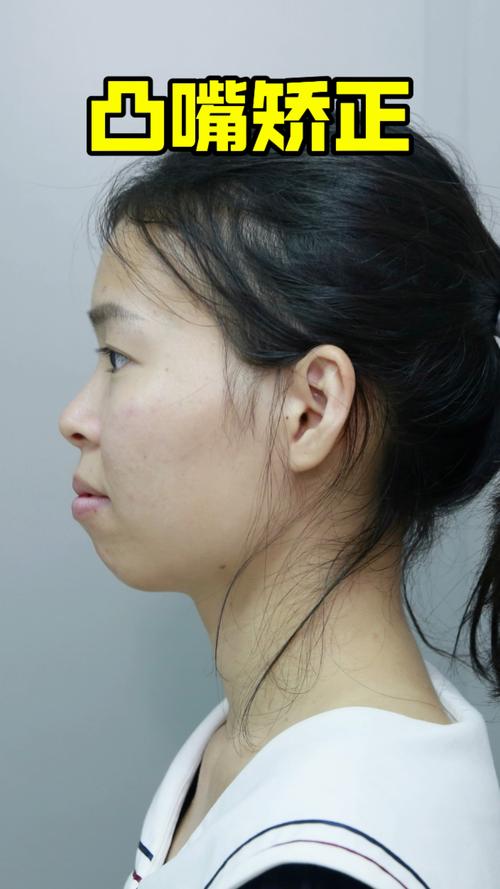 矫正牙齿后嘴巴突出,是矫正效果问题吗?原因是什么?-图1 矫正牙齿后嘴巴突出,是矫正效果问题吗?原因是什么?-图1