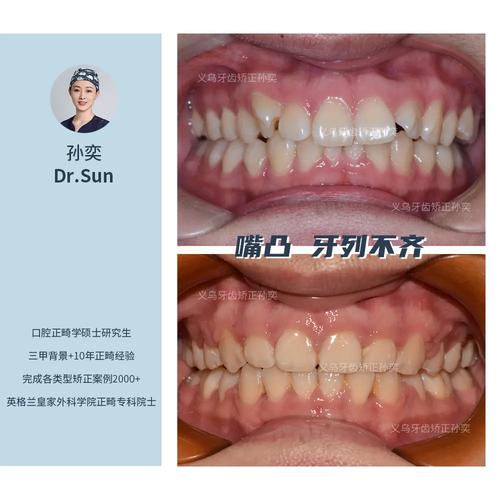 矫正牙齿后嘴巴突出,是矫正效果问题吗?原因是什么?-图2 矫正牙齿后嘴巴突出,是矫正效果问题吗?原因是什么?-图2