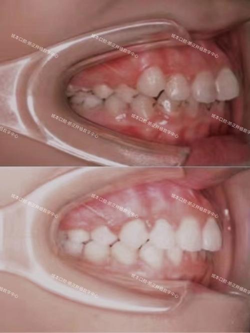 拔牙后可以矫正牙齿-图1