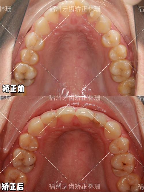 福州牙齿矫正有哪些靠谱选择和方法？-图3