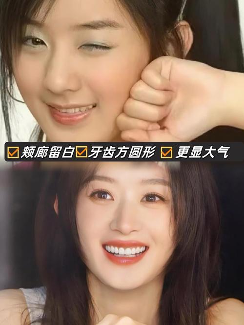 哪些明星矫正过牙齿？看看他们如何通过牙齿变美变自信-图1