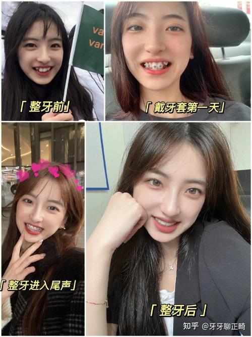 格莱美牙齿矫正好吗-图2 格莱美牙齿矫正好吗-图2