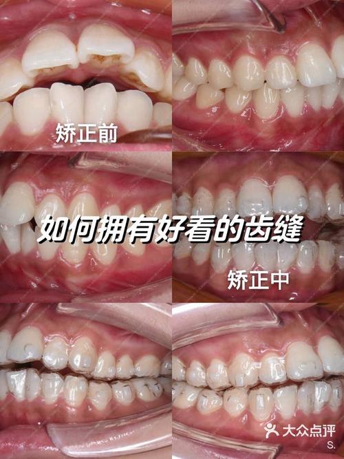 杭州牙齿矫正哪家最出名？怎么选才靠谱？-图2