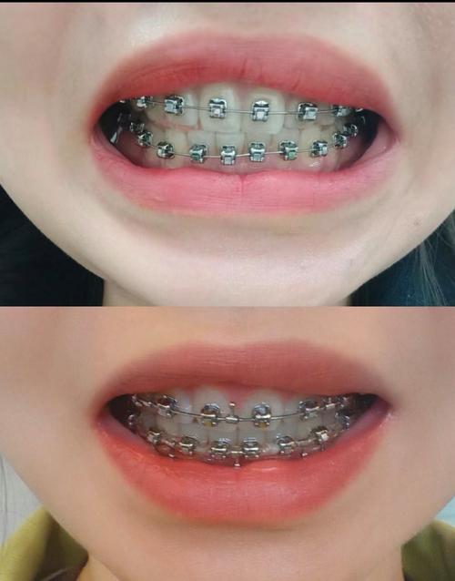 合肥哪家矫正牙齿好-图1 合肥哪家矫正牙齿好-图1