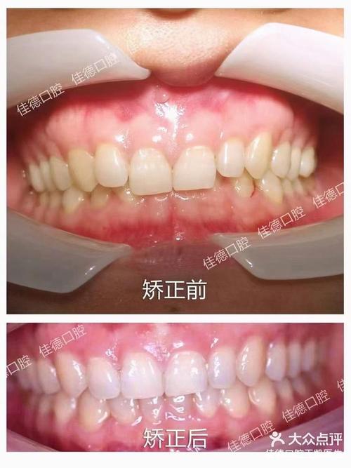 合肥哪家矫正牙齿好-图2 合肥哪家矫正牙齿好-图2