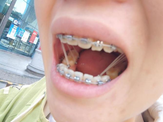 27岁矫正牙齿晚不晚?成年人矫正效果会受年龄影响吗?-图3 27岁矫正牙齿晚不晚?成年人矫正效果会受年龄影响吗?-图3