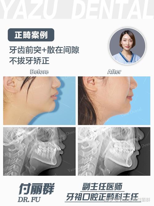 拔牙矫正收缝隙，过程要多久？怎么收才有效？-图2