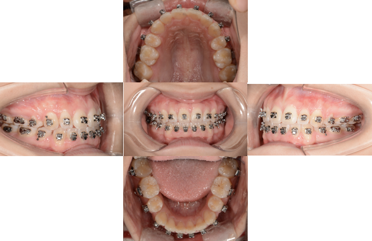 拔牙矫正收缝隙，过程要多久？怎么收才有效？-图1