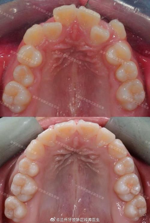 拔牙矫正收缝隙，过程要多久？怎么收才有效？-图3