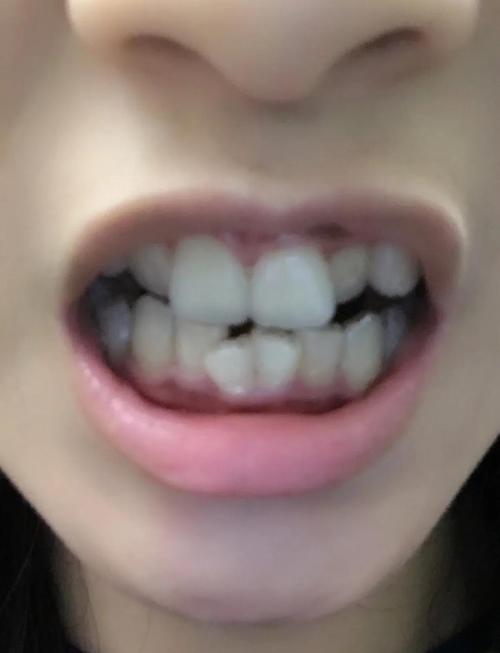 做过隐形矫正牙齿吗?效果、舒适度怎么样?过来人聊聊!-图1 做过隐形矫正牙齿吗?效果、舒适度怎么样?过来人聊聊!-图1