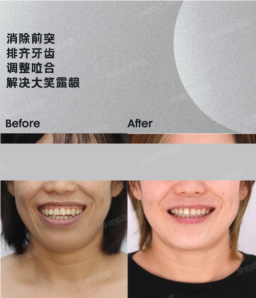 上海矫正牙齿哪家好-图3