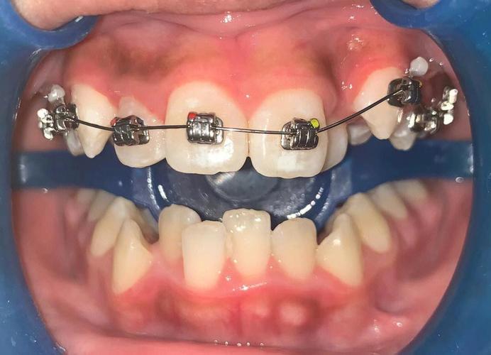 矫正牙齿托槽怎么选？哪种更适合？-图1