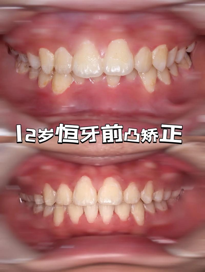 12岁矫正牙齿正当时？关键事项家长需注意-图1