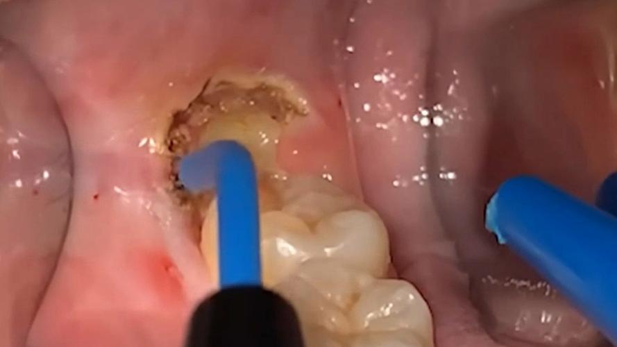 矫正牙齿期间拔智齿-图1