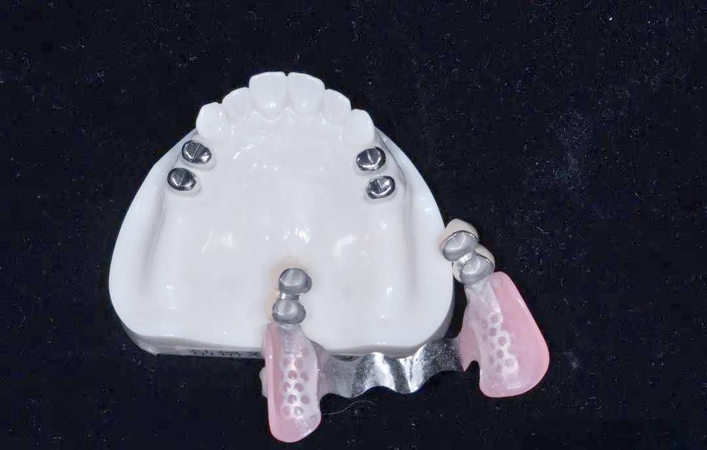 仿生美容冠矫正牙齿的效果能像真牙一样自然持久吗？-图1