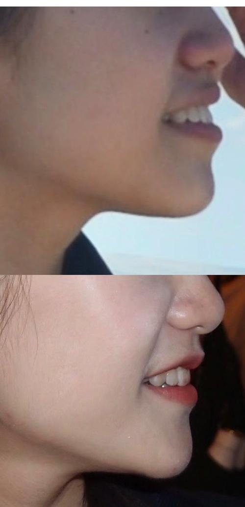 矫正牙齿后有点龅牙-图1