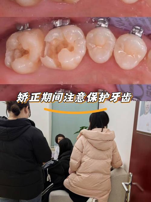 牙齿矫正 口腔溃疡-图2