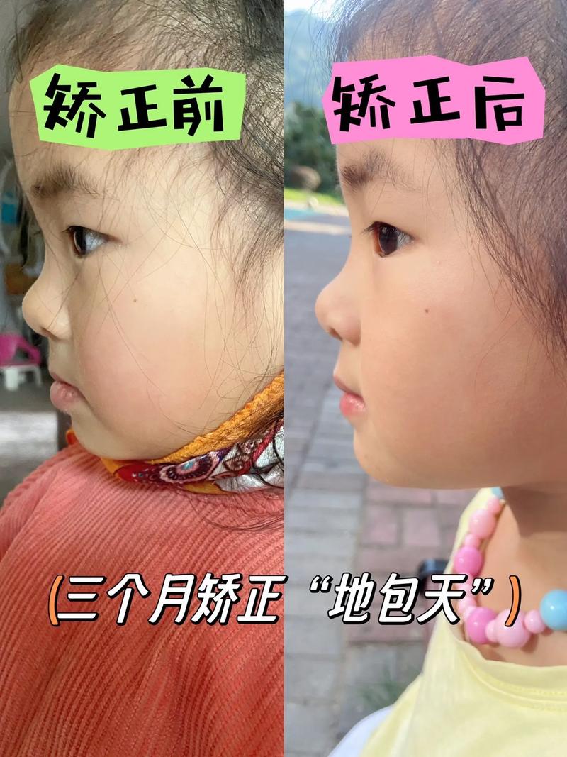 矫正地包天图片能真实展示矫正效果吗？-图1