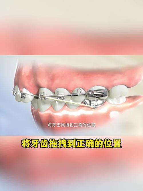 牙齿矫正图片能直观呈现矫正效果吗？-图3