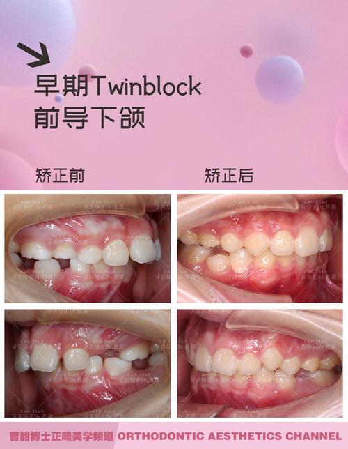 矫正牙齿为什么会导致下颌响？-图3