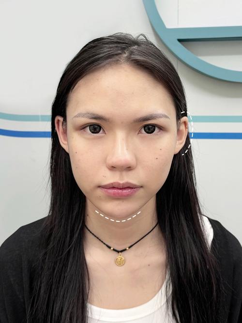 牙齿矫正后脸颊凹陷-图2