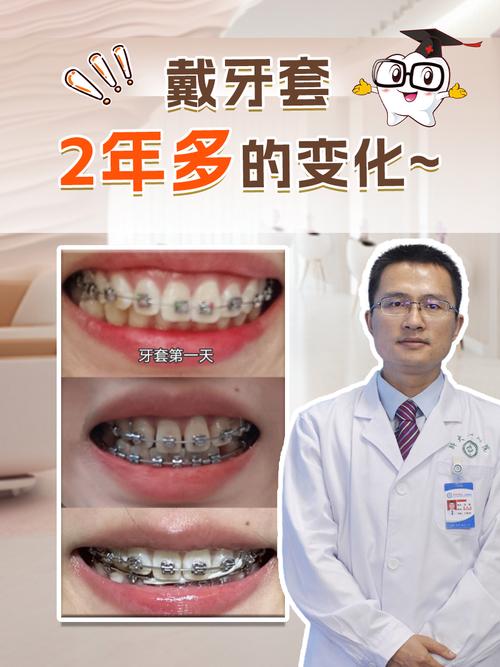 牙齿严重矫正要多久-图2
