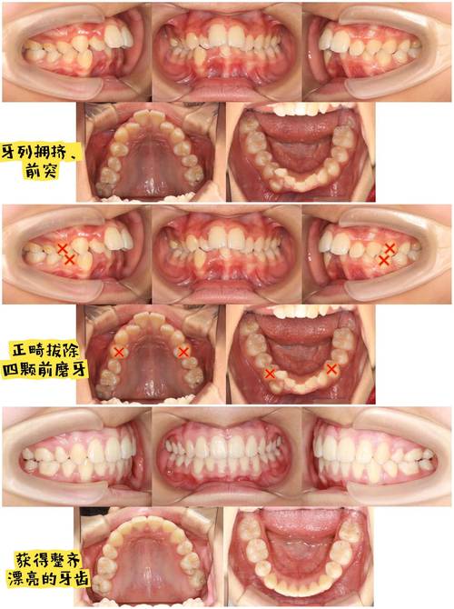 矫正牙齿是否可以拔牙？-图2