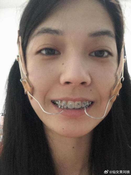 矫正牙齿的头帽图片-图2