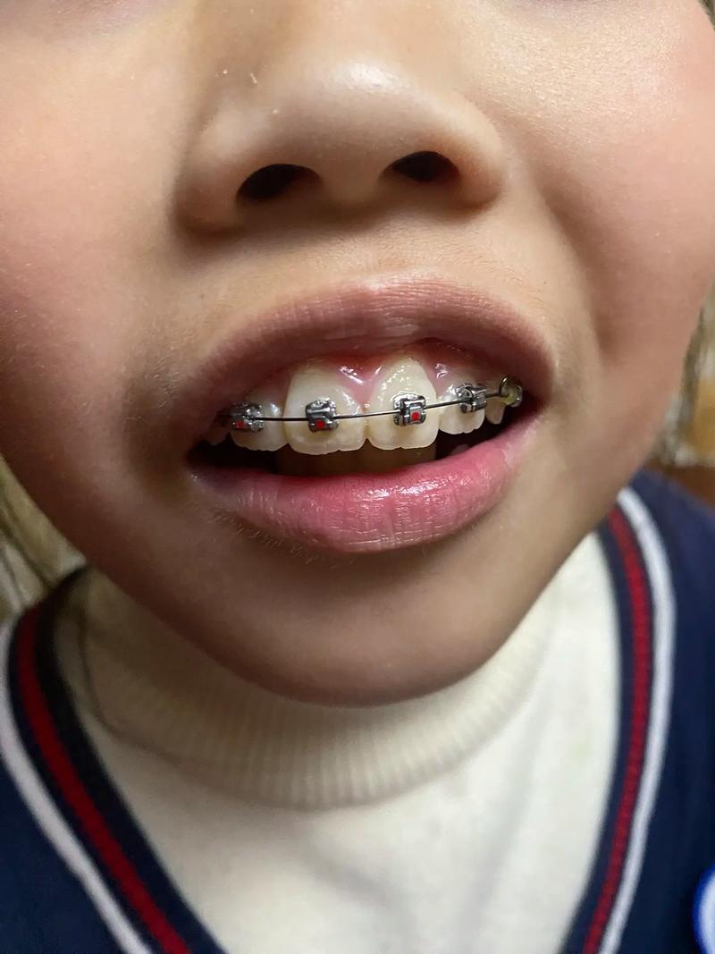 儿童牙齿矫正疼不疼?家长必知的疑问解答-图3 儿童牙齿矫正疼不疼?家长必知的疑问解答-图3