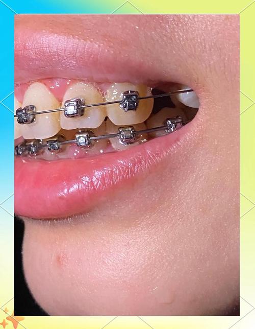 武汉矫正牙齿哪家好？专业机构怎么选？-图1