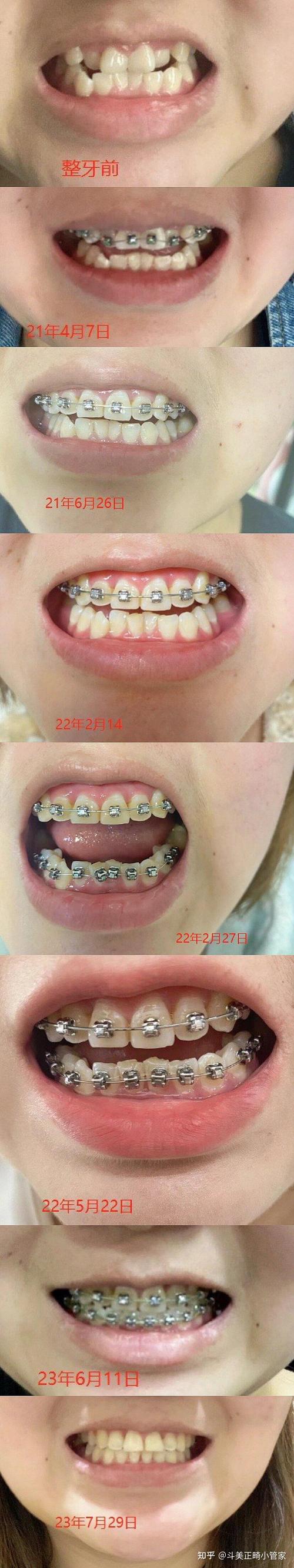 上海牙齿矫正有哪些常见的矫正方式、类型和选择方案？-图3