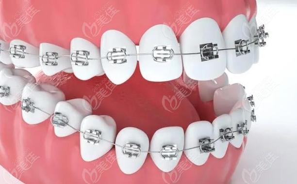 合肥矫正牙齿去哪里好？-图1