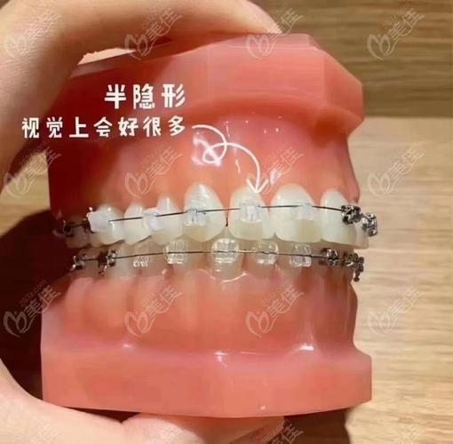 昆山哪家牙齿矫正好-图2 昆山哪家牙齿矫正好-图2