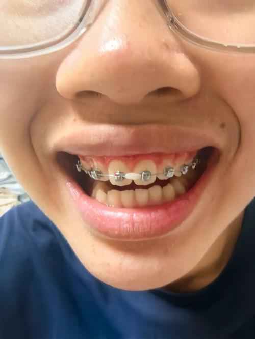 25岁矫正牙齿，后悔的年龄坎为何难迈？-图1