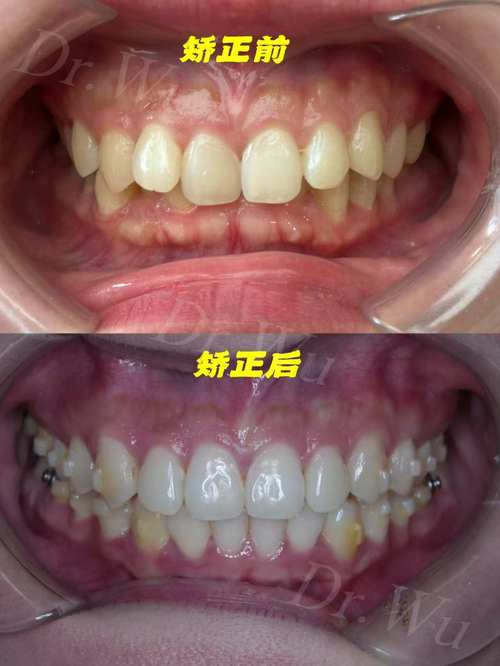 矫正牙齿每次加力后-图2