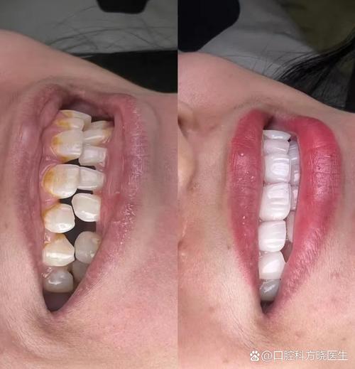 矫正牙齿后出现大牙缝，是矫正不当还是正常现象？-图1