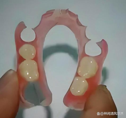 陶瓷全隐形矫正牙齿，真的隐形又有效吗？-图3