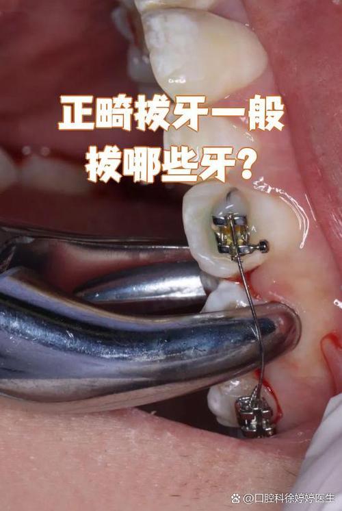 矫正牙齿为何要拔一颗?拔牙的必要性是什么?-图2 矫正牙齿为何要拔一颗?拔牙的必要性是什么?-图2