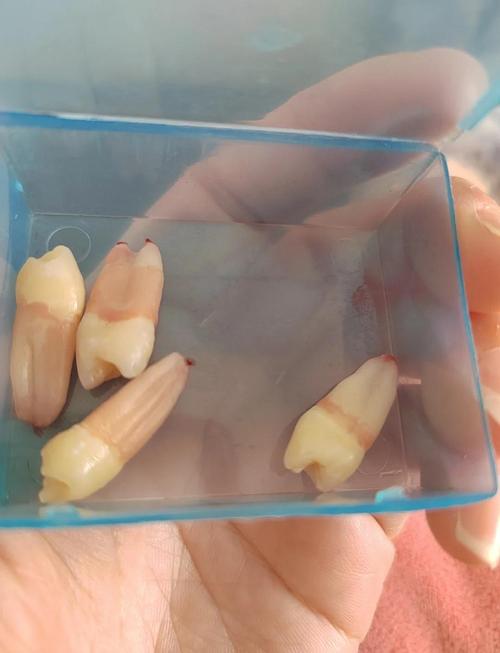 矫正牙齿为何要拔一颗?拔牙的必要性是什么?-图3 矫正牙齿为何要拔一颗?拔牙的必要性是什么?-图3
