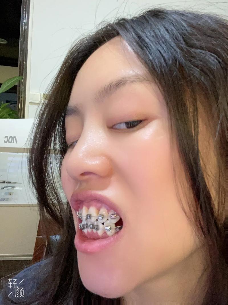 牙齿矫正后为何总疼？是正常反应还是出问题了？-图3