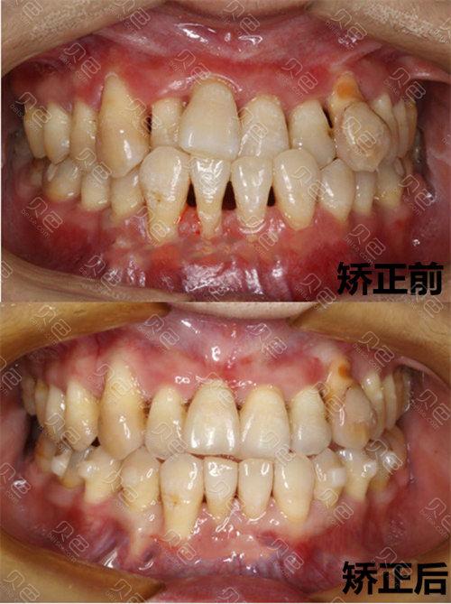 矫正牙齿过程中得了牙周炎，是什么原因导致的？该如何正确处理？-图1