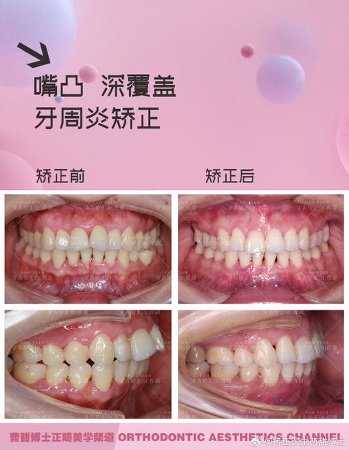 矫正牙齿过程中得了牙周炎，是什么原因导致的？该如何正确处理？-图2