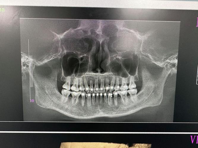 牙齿矫正会导致牙根吸收吗？风险、原因及预防方法有哪些？-图1