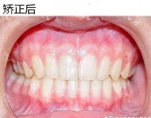 格莱美口腔牙齿矫正效果如何?靠谱吗?-图1 格莱美口腔牙齿矫正效果如何?靠谱吗?-图1