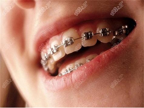 格莱美口腔牙齿矫正效果如何?靠谱吗?-图2 格莱美口腔牙齿矫正效果如何?靠谱吗?-图2