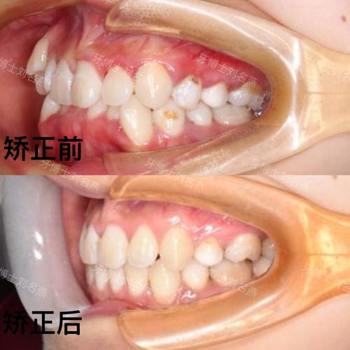 牙齿矫正后牙齿内缩，是正常现象还是需关注？-图3