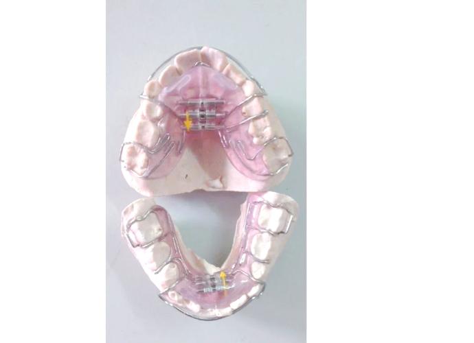 活动矫正器矫正牙齿效果如何？适合哪些牙齿问题？佩戴需要注意什么？-图2
